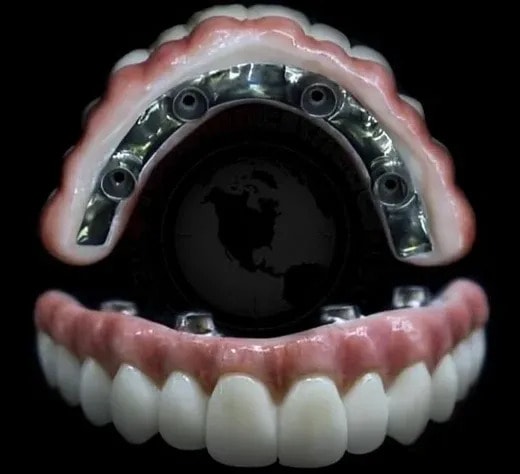 All-on-Four implant destekli protez - Üst ve alt çene tam protez seti